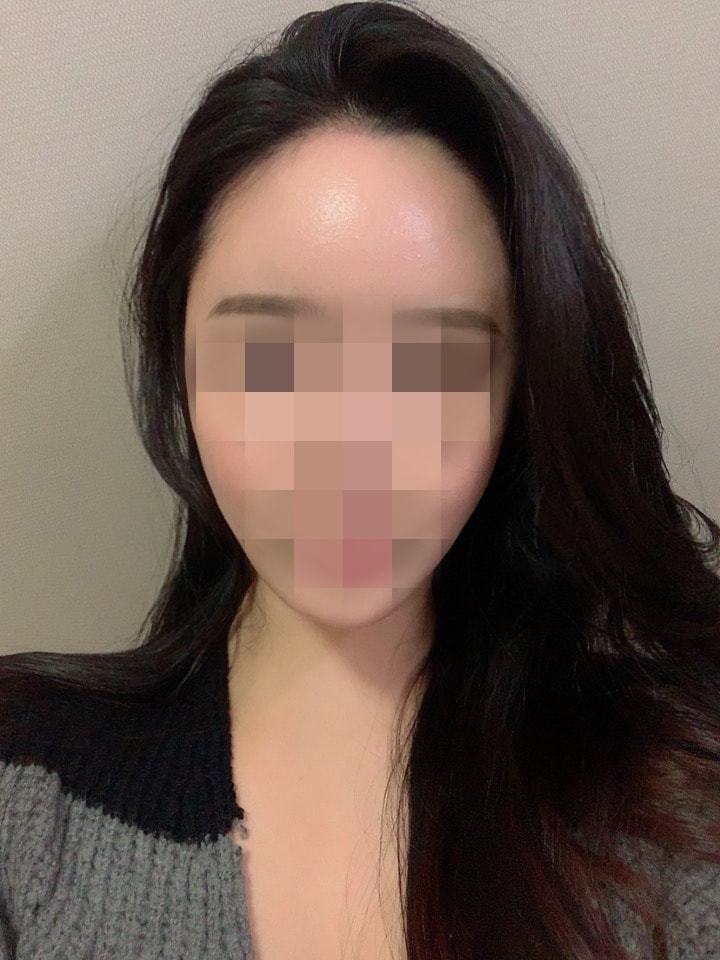 ヘアラインしてからもう二ヶ月が過ぎましたww