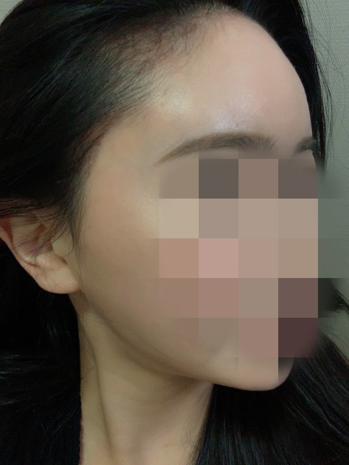 수술두달03.jpg
