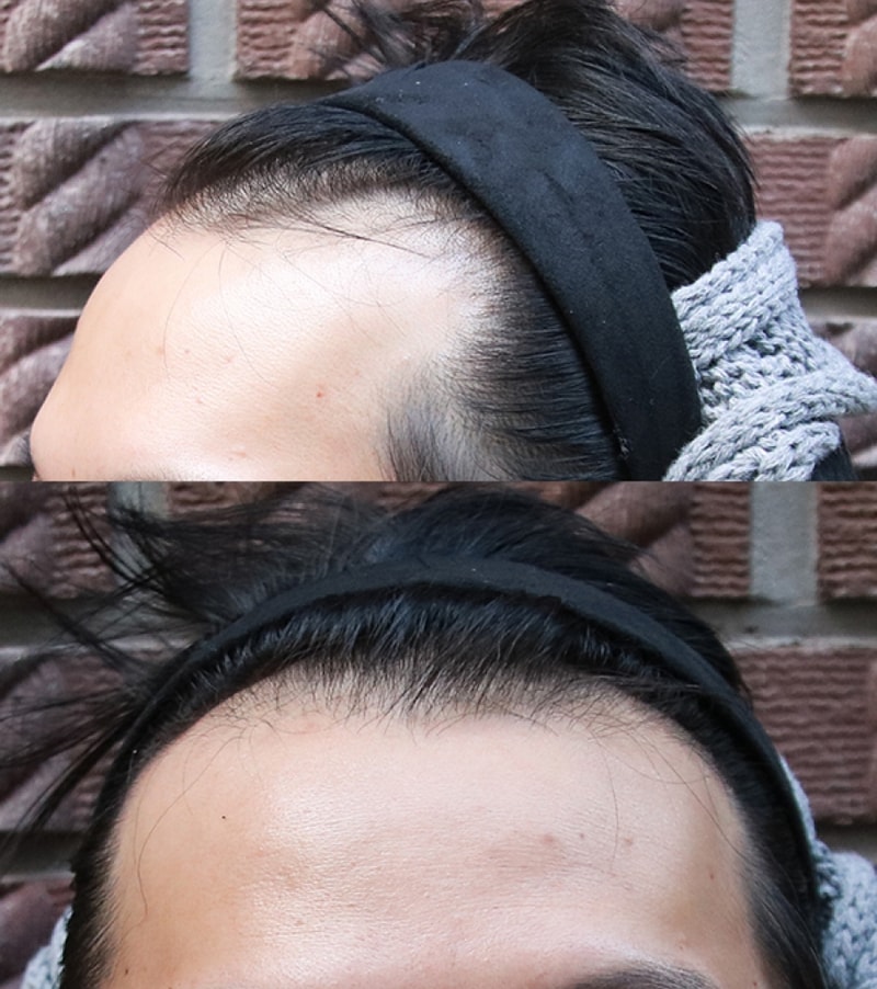 수술전.jpg