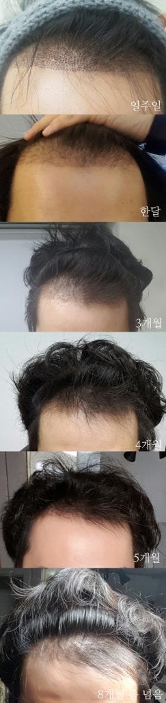 수술후.jpg