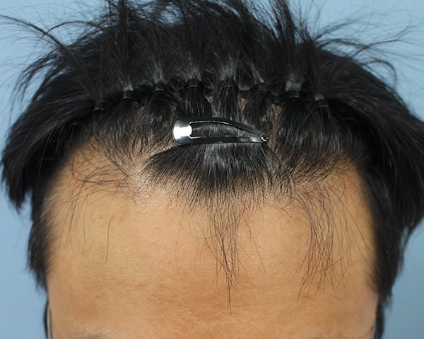 5th Month of Hair Transplantation Review