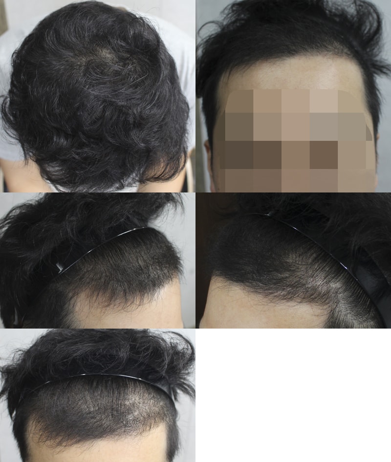 切開3600毛、4ヶ月になりました~~