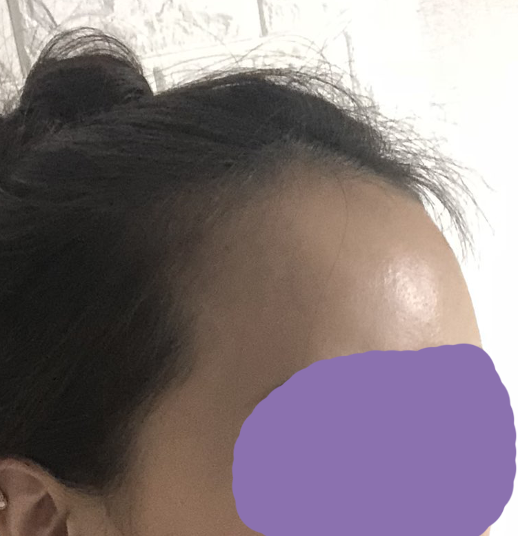 カットヘアラインが1ヶ月半になりました！