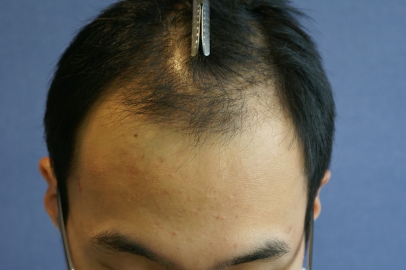 Motion 1400 hair follicle surgery review~! (6 months and 15 days have passed)