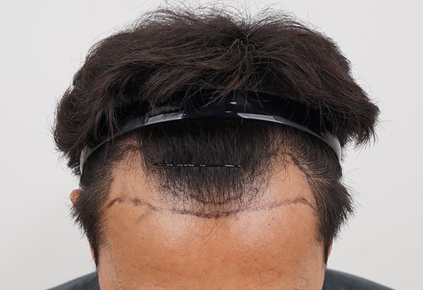 M-shaped 2700 Mo 2 weeks, thread has been removed.