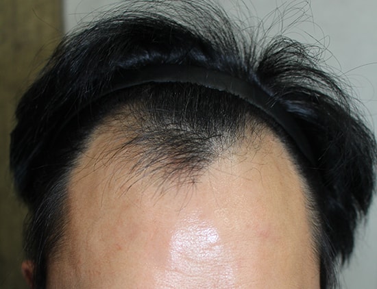 5年前に毛髪移植を受けて今回2次手術をしました。