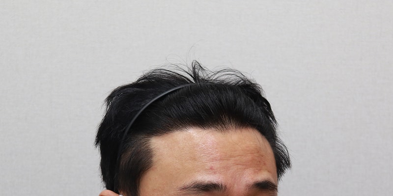 7. 1년 1개월 경과.JPG