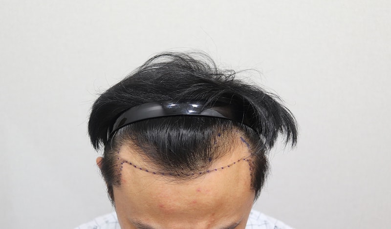 1.수술전.JPG