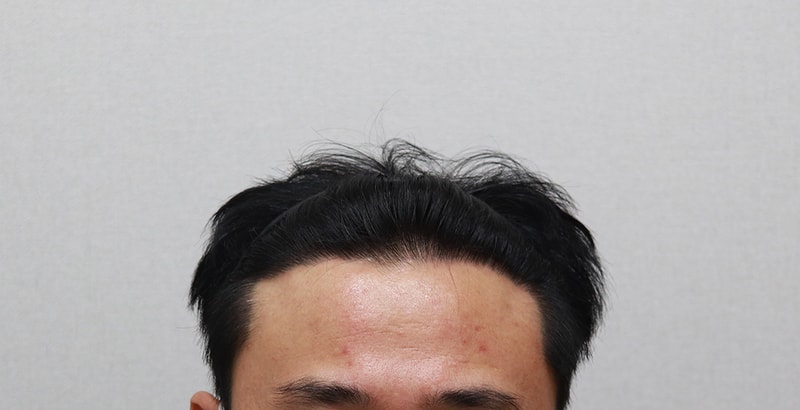 5. 1년 1개월 경과.JPG