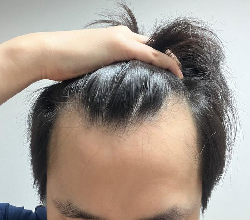 狎鸥亭FORHAIR医院非切开毛发移植M字脱发一年后记！非常感谢