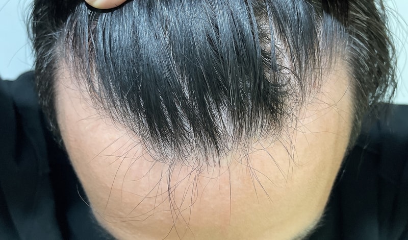 서울 포헤어 정대건원장님 수술당일