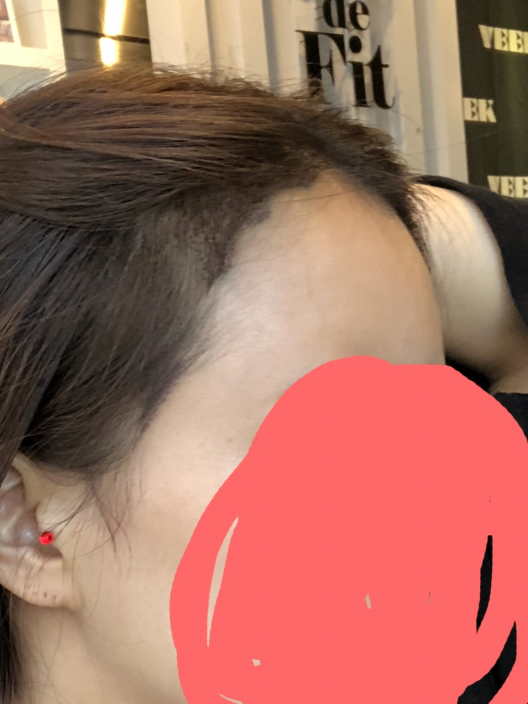 수술2일.png