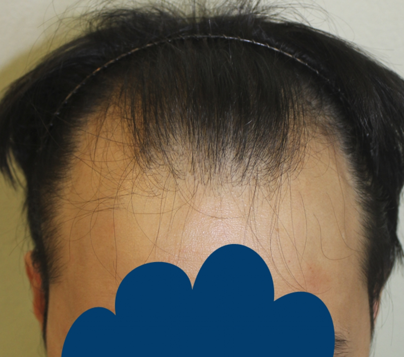 모발이식전1.png
