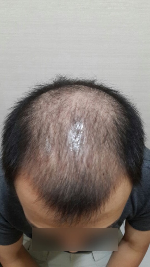 다나 모발이식후기 남깁니다