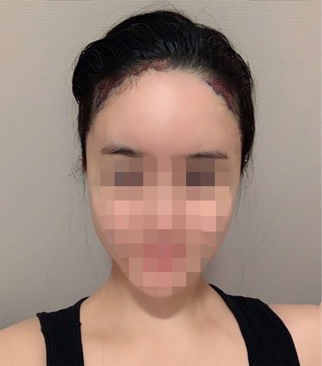モプラス ヘアライン 11ヶ月