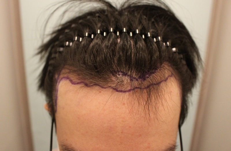 10 months transplant to M-shaped lines and lateral scarring!