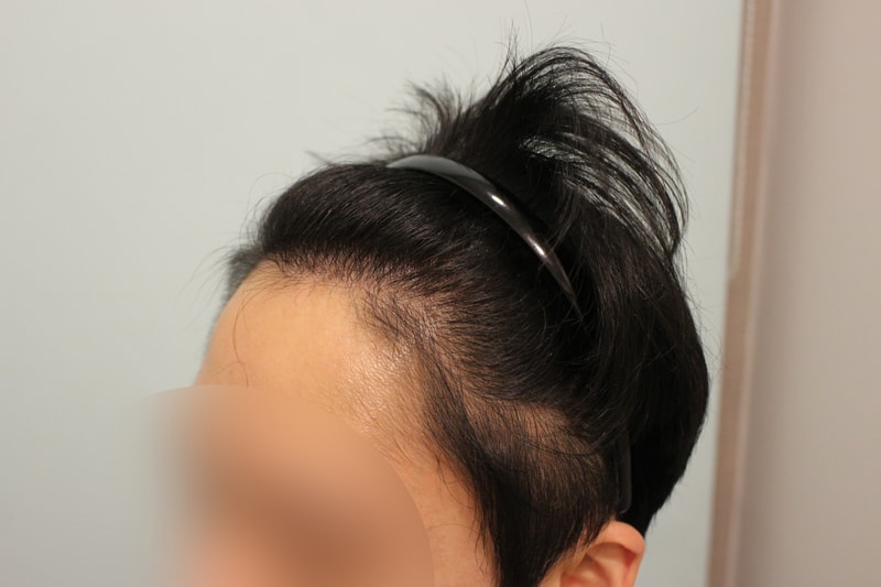 수술후 9개월 3.jpg