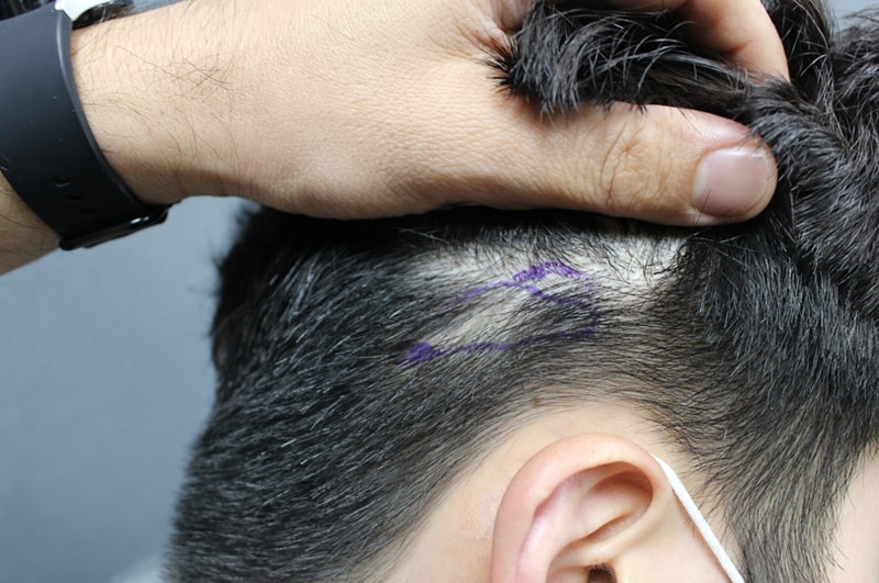 Hair transplant to scar on the back of the ear - Doctor Kim Joo-yong