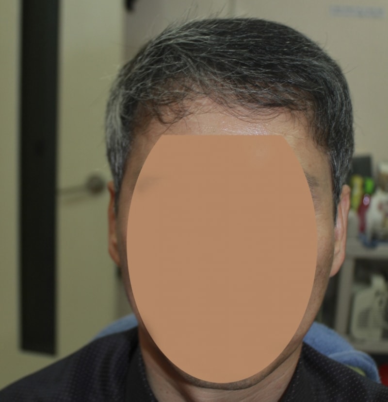 모발이식후_01.jpg