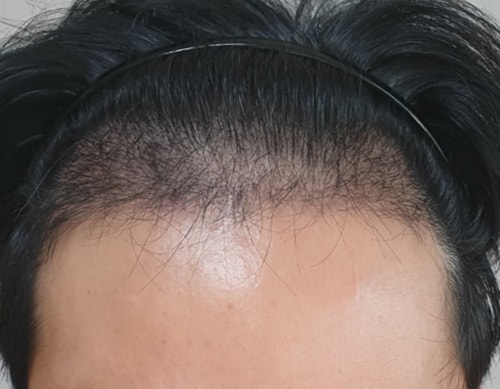 Non-cutaneous 4000-mo transplantation 4 months later