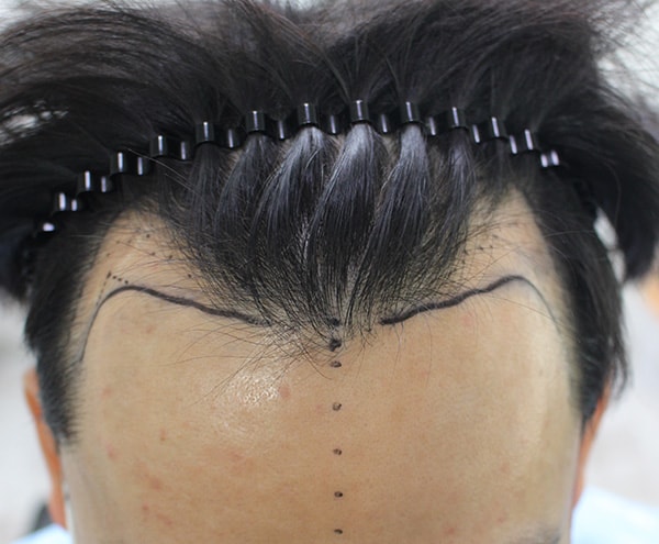 Here is the final review of 13 months of Hannaive M-shaped hair loss transplantation.