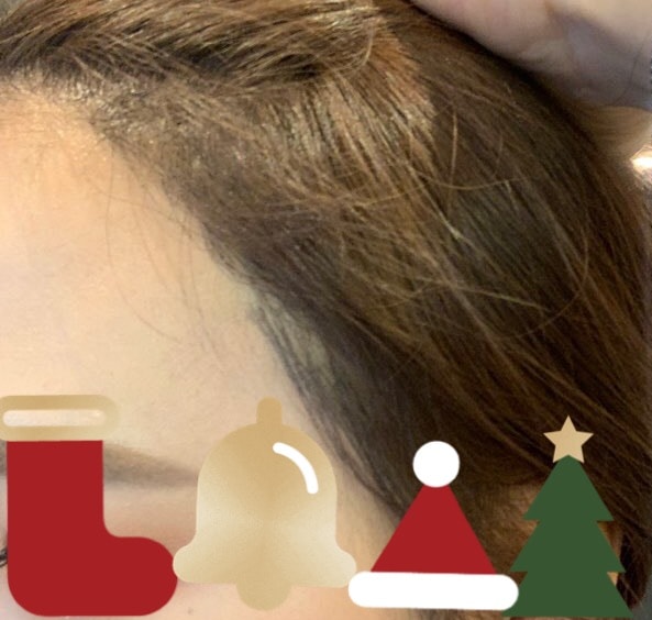ヘアライン移植7ヶ月（ダナ整形外科）