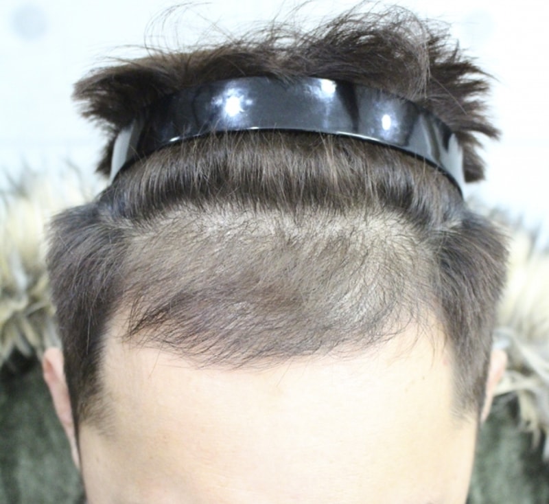 모발이식후_3.jpg