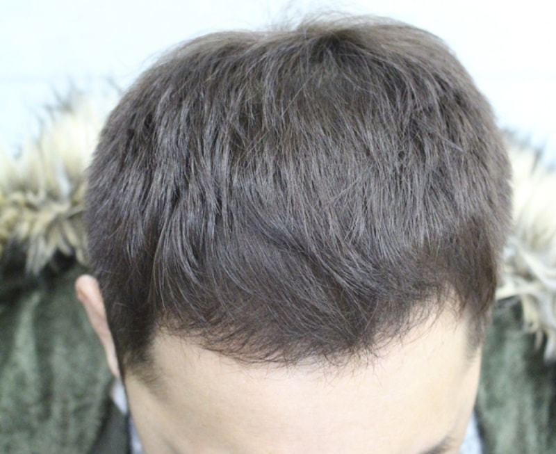 모발이식후_2.jpg
