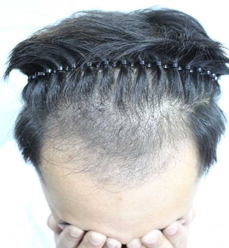 모발이식전_2.jpg