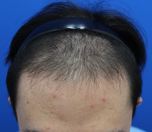 절개 3118모 수술 6개월 모발이식 후기 남겨요