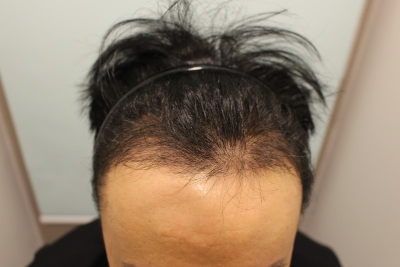 수술후 3개월 3.JPG