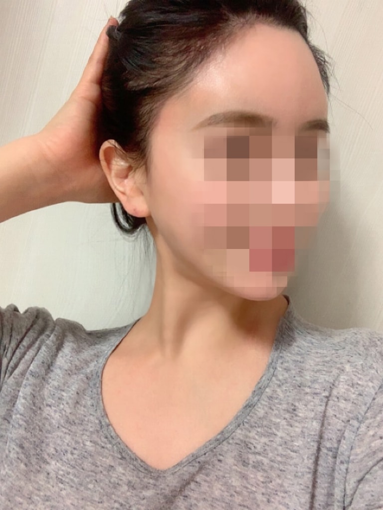 ヘアライン5ヶ月目のレビュー！ もう暗黒期も終わったようです