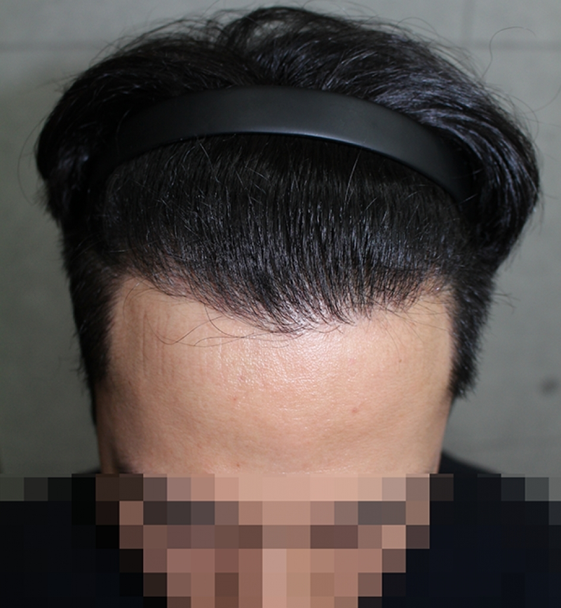 수술후.png