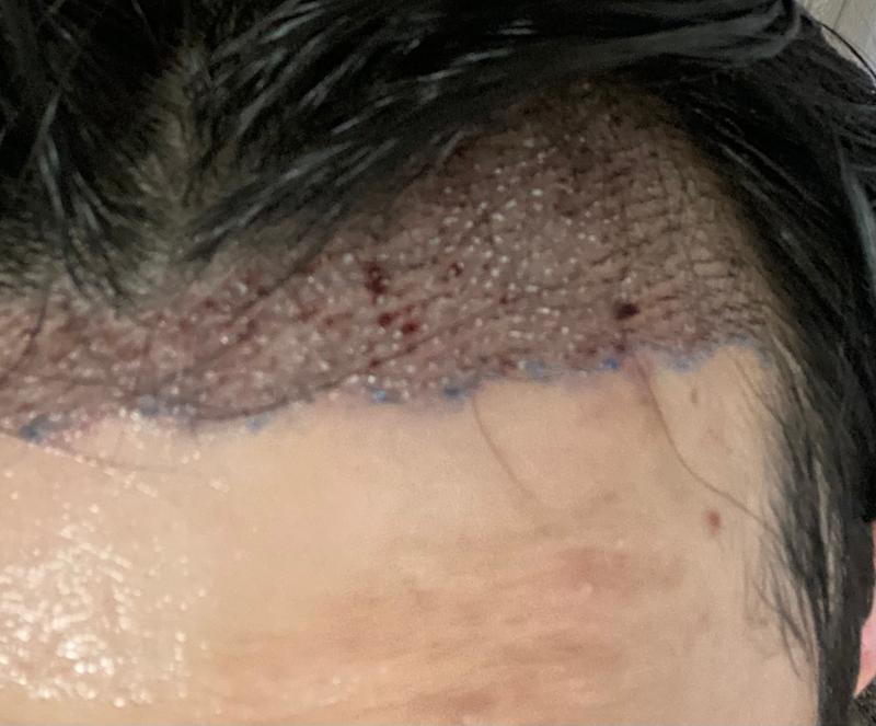 The review of the surgery for MoPlus 3,500mo + 200mo