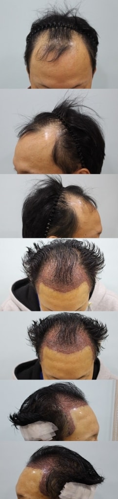 수술전후.jpg
