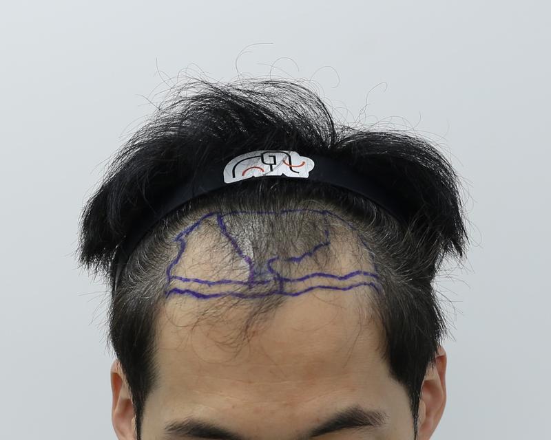 Apgujeong Mamos Hairline Non-cut Hair Transplant Surgery 10 Months Later
