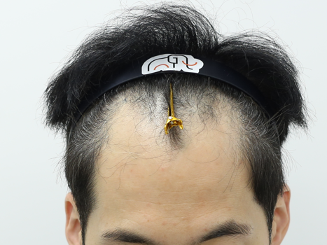 Apgujeong Mammoth Hairline Clinic's Second Week of Hair Transplantation