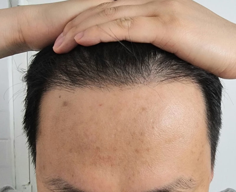 毛材性非切开毛发移植8个月后期