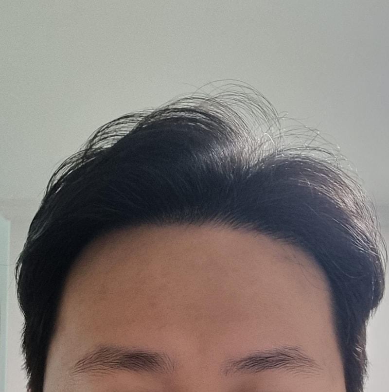 毛材性非切开毛发移植 12 个月后期