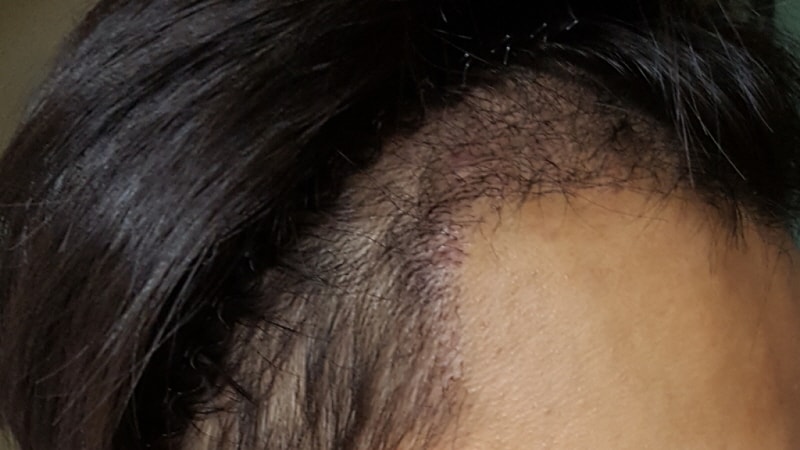1 month has passed since the implantation of motion 1250 hair follicles (2500 m).