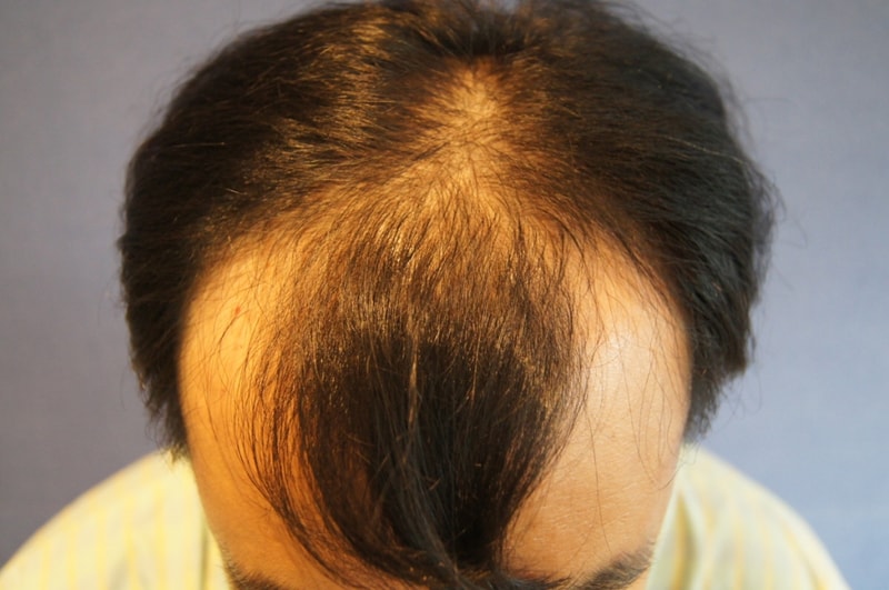 Motion 1600 Hair follicle 9 months after hair transplantation