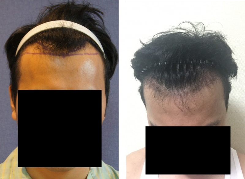 1200毛包 非切開 毛髪移植 8ヶ月の写真です