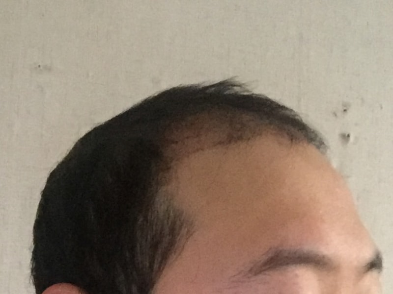 モーション4ヶ月経過 - 1600毛包ヘアラインの手術写真です