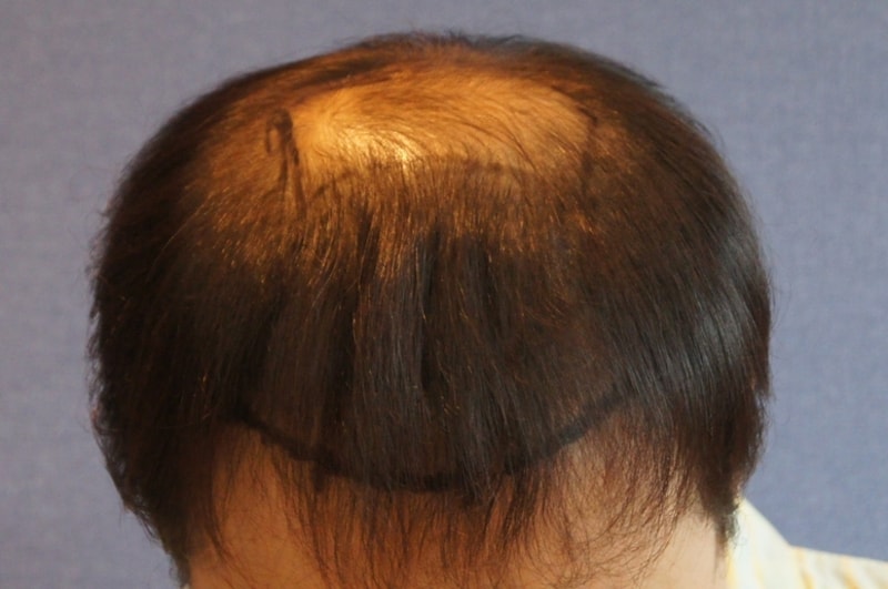 Motion 2800 hair follicle hairline + upper limb hair transplantation 7 months later