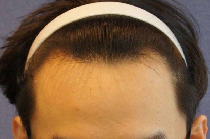 モーション1400 毛包 ヘアライン移植 9ヶ月 レビュー