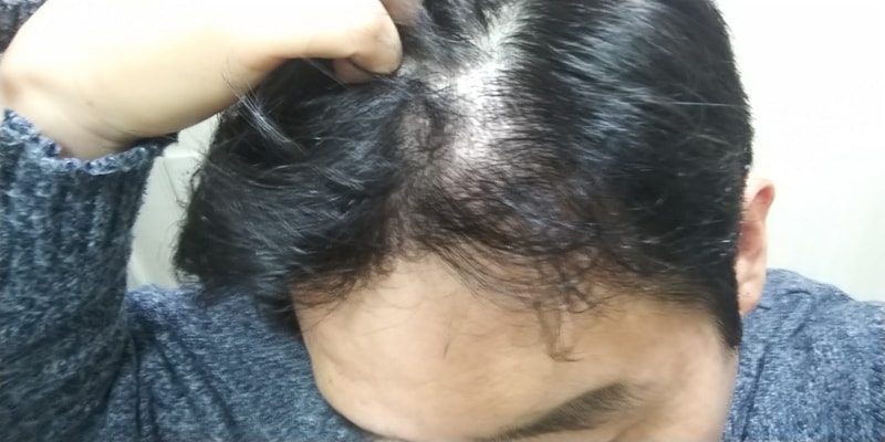 수술후 8개월 경과