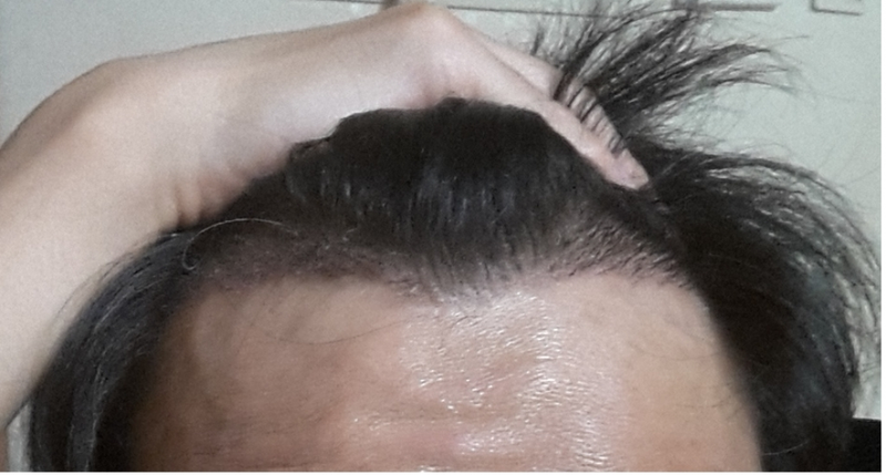 Motion 800 follicle transplant day 11 late.