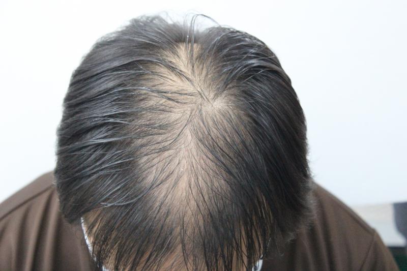 수술전_위.jpg