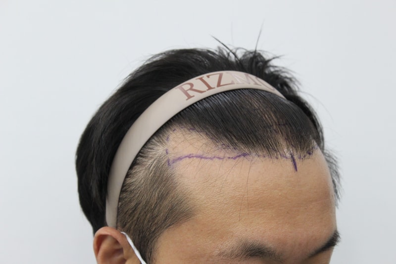 수술전_우측_헤어밴드.jpg