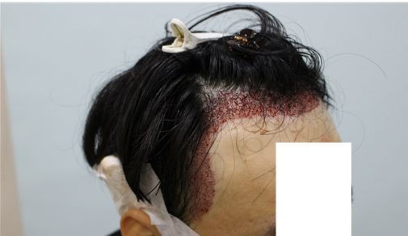 수술후3.JPG